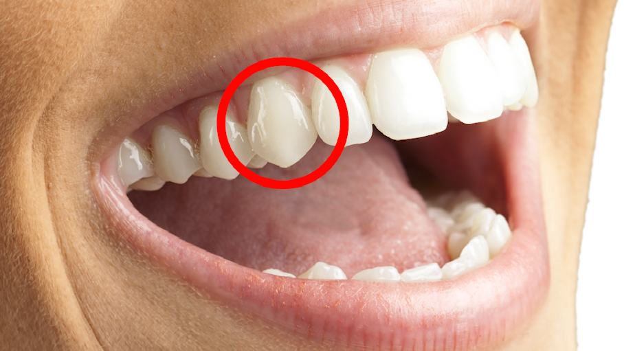Fangs of Function: Understanding Canine Teeth in Humans and Animals